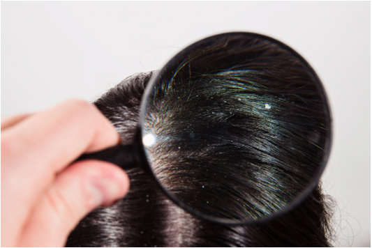 Understanding the Connection Between Dandruff and Hair Thinning! Featured Image 1136599