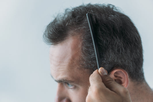 Receding Hairline Lead to Baldness! Featured Image 1102
